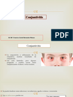 CONJUNTIVITIS