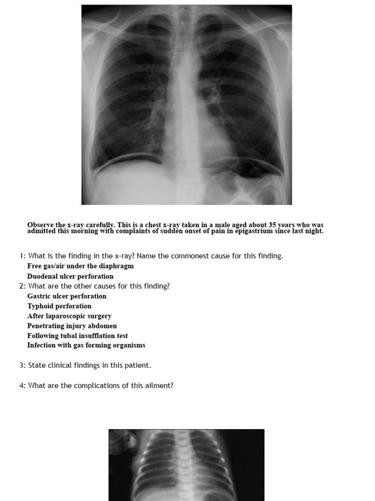 Free Air Under Diaphragm Causes | PDF