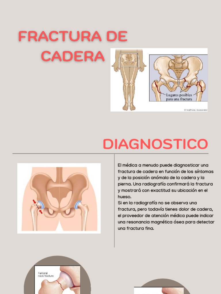 Diagnóstico y Tratamiento de Fractura de Cadera | PDF