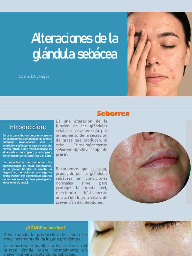 alteraciones-de-la-gl-ndula-seb-cea-pdf-piel-sistema-tegumentario