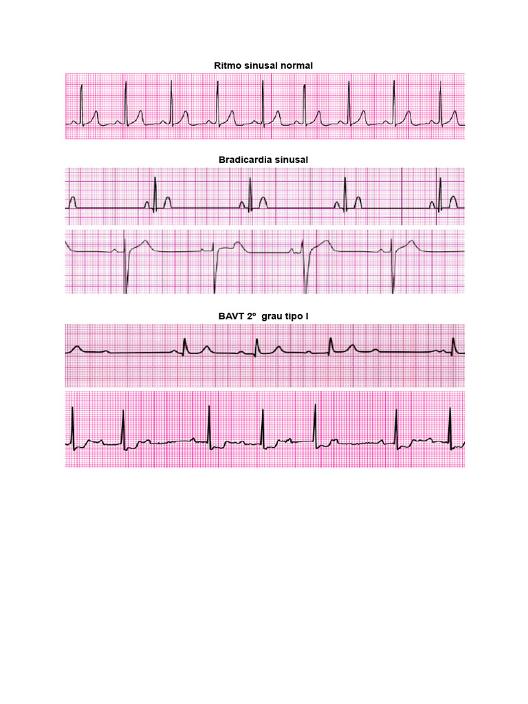 Ritmos Cardíacos e Emergências ACLS | PDF