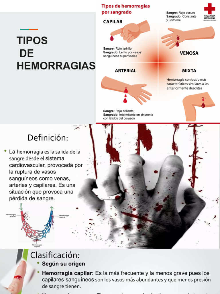 Tipos de Hemorragias y Heridas | PDF | Sangrado | Piel