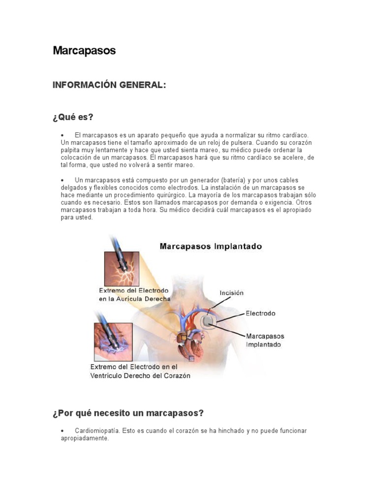 Marcapasos Marcapasos cardíaco artificial Corazón