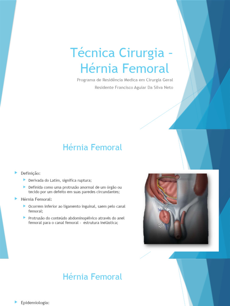 Técnica McVay na Hérnia Femoral | PDF | Anatomia