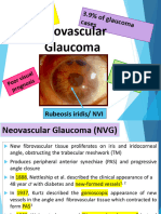 Rana Greene Neovascular Glaucoma
