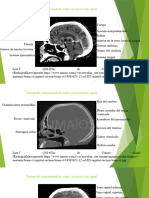 Tomografía Computarizada de Cráneo Con Proyección Coronal