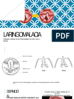 Laringomalacia