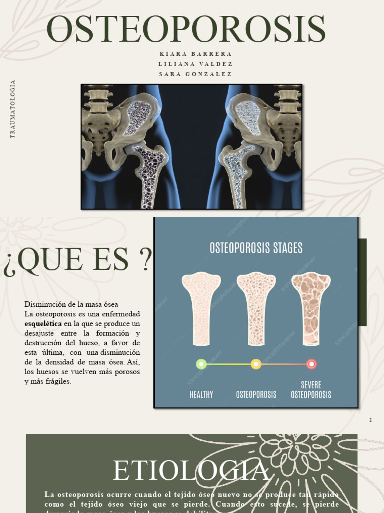 Guía Completa sobre Osteoporosis | PDF | Osteoporosis | Hueso