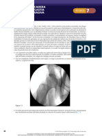 7 - Artroscopia de Cadera y Osteocondroplastia Mínimamente Invasiva