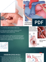 Comunicación Interventricular