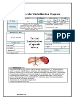 Partial Embolization of Splenic Artery