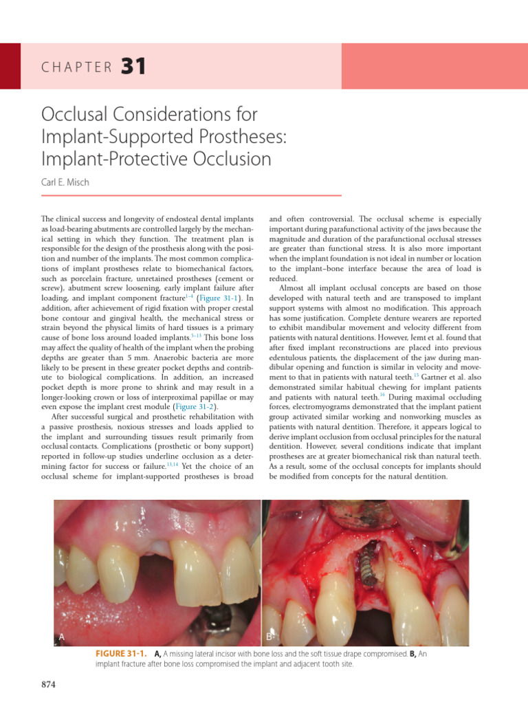 Occlusal Considerations For ImplantSupported Prostheses Implant