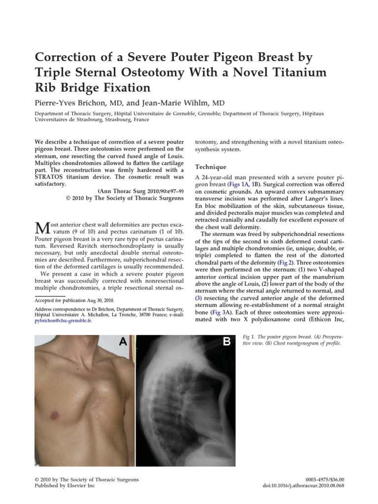 Triple Osteotomy for Pouter Pigeon Breast | PDF | Thorax (Human Anatomy ...