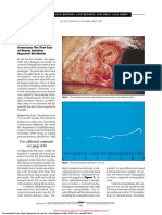 Primary Aberrant Oculomotor Nerve Regeneration From A Posterior Communicating Artery Aneurysm (PDFDrive)