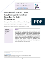 Simultaneous Esthetic Crown Lengthening and Frenotomy Procedure For Smile Rejuvenation