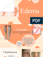 edema 1