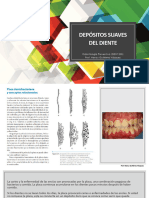Depósitos suaves del diente
