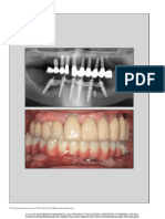 Double Duplicate Technique For Cad Cam Full Arch Immediate Loading A Technical Description and Case Report