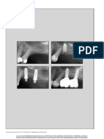 Three-Dimensional Bone Augmentation and Immediate Implant Placement Via Transcrestal Sinus Lift 8-Year Clinical Outcomes