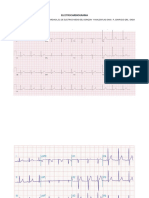 Electrocardiogramas Tarea