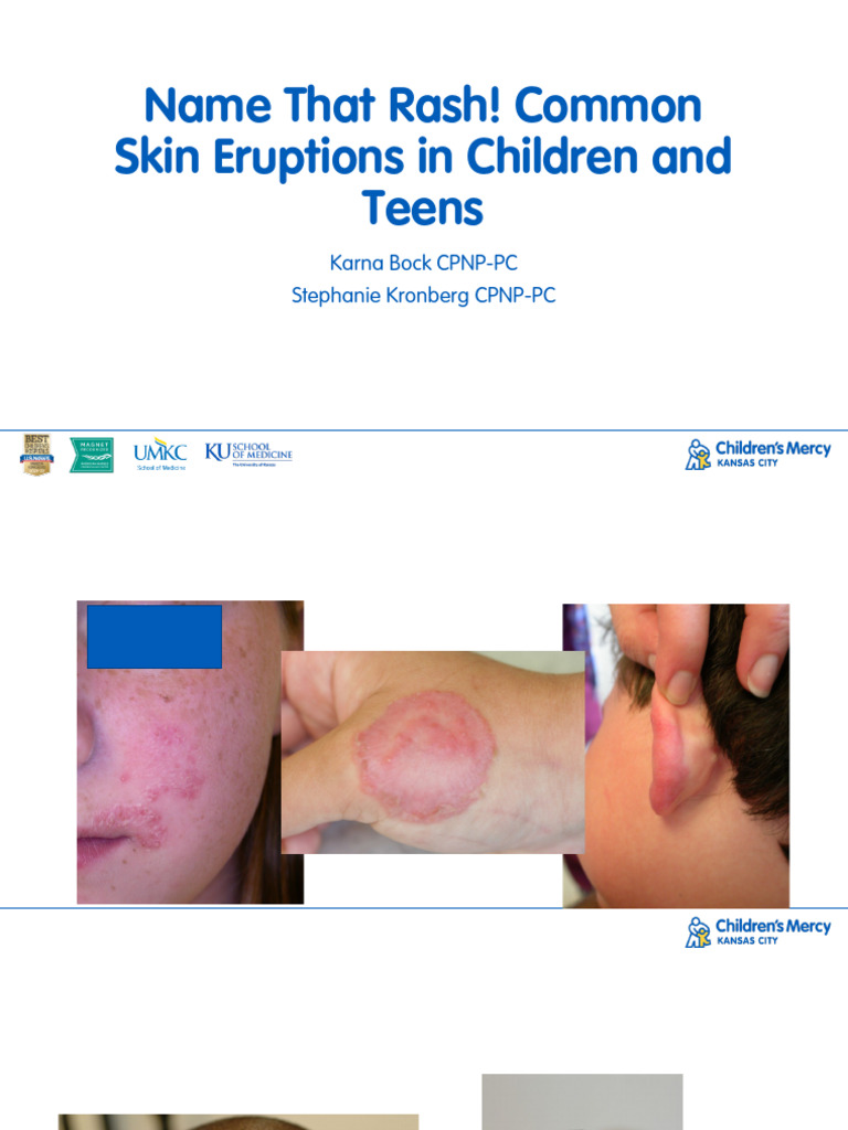Name That Rash Common Skin Eruptions in Children | PDF | Cutaneous ...