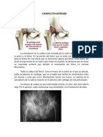 Artrosis de Cadera (Coxartrosis) (2)