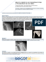 Pseudoartrosis de Espina de Escápula Tras Un Traumatismo de Baja Energía. Presentación de Un Caso Clínico