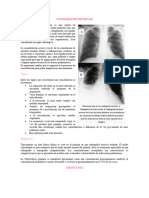 Consolidación Pulmonar