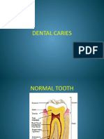 Dental Caries