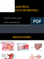 Mucosa Gastrica (Diverticulo de Meckel)