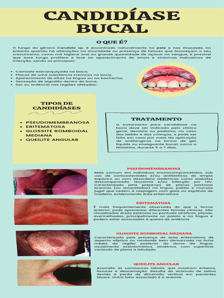 Candidíase Oral | PDF | Candidíase | Boca