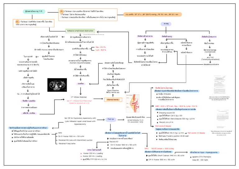 Concept Mapping Adhesive Small Bowel Obstruction | PDF
