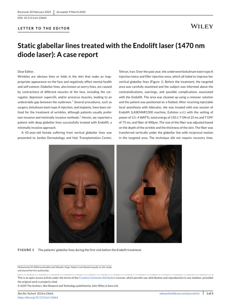 static-glabellar-lines-treated-with-the-endolift-laser-1470-nm-diode