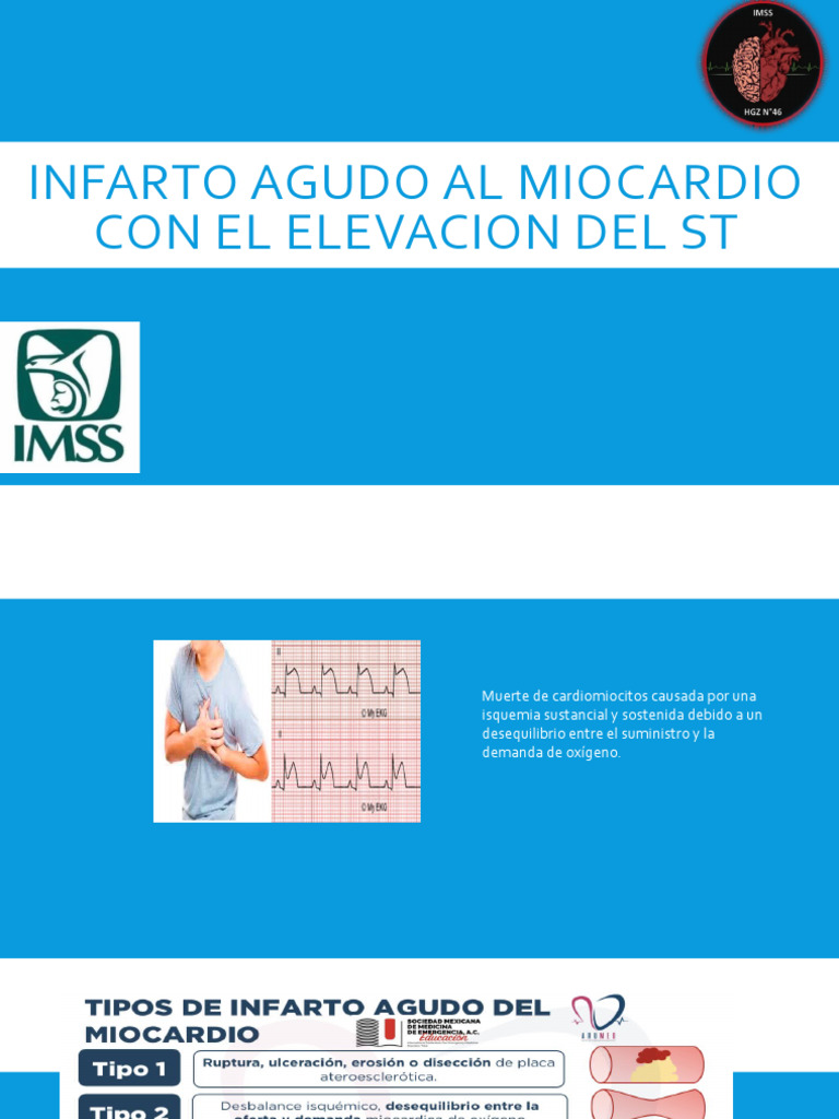 Infarto Agudo Al Miocardio Con El Elevacion Del ST | PDF | Infarto de ...