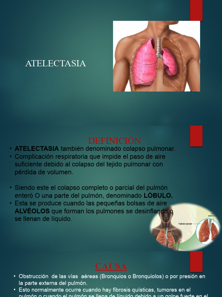 Causas y Tratamientos de Atelectasia | PDF | Arte | Salud y bienestar