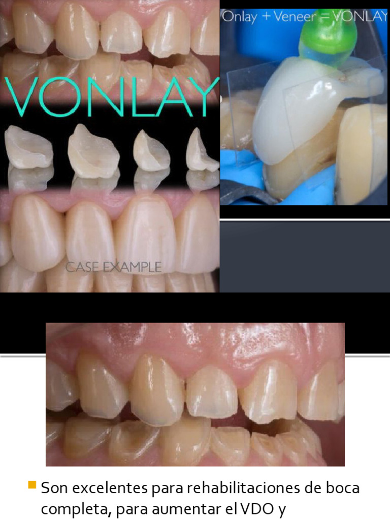 Técnica Onlay en Rehabilitación Dental | PDF