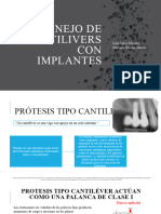 Cantiliever en Implantes
