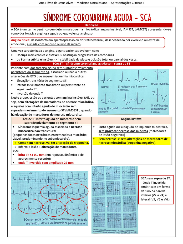 Síndrome Coronariana Aguda: Diagnóstico e Tratamento | PDF | Infarto do ...