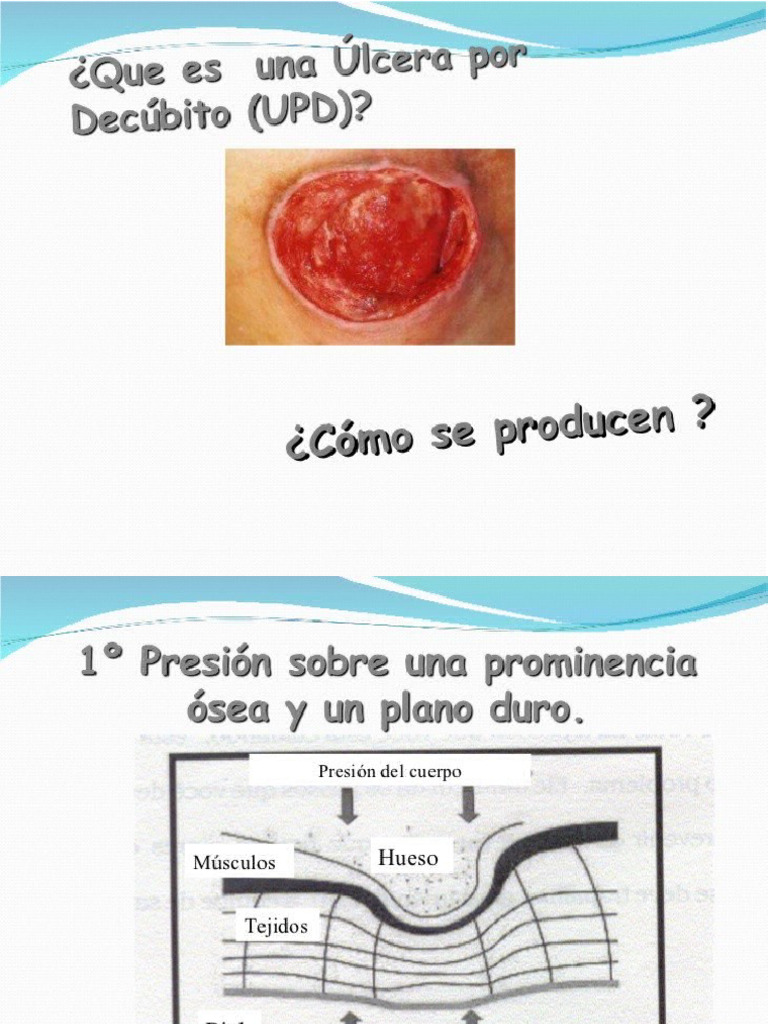 Ulceras Por Decubito | PDF