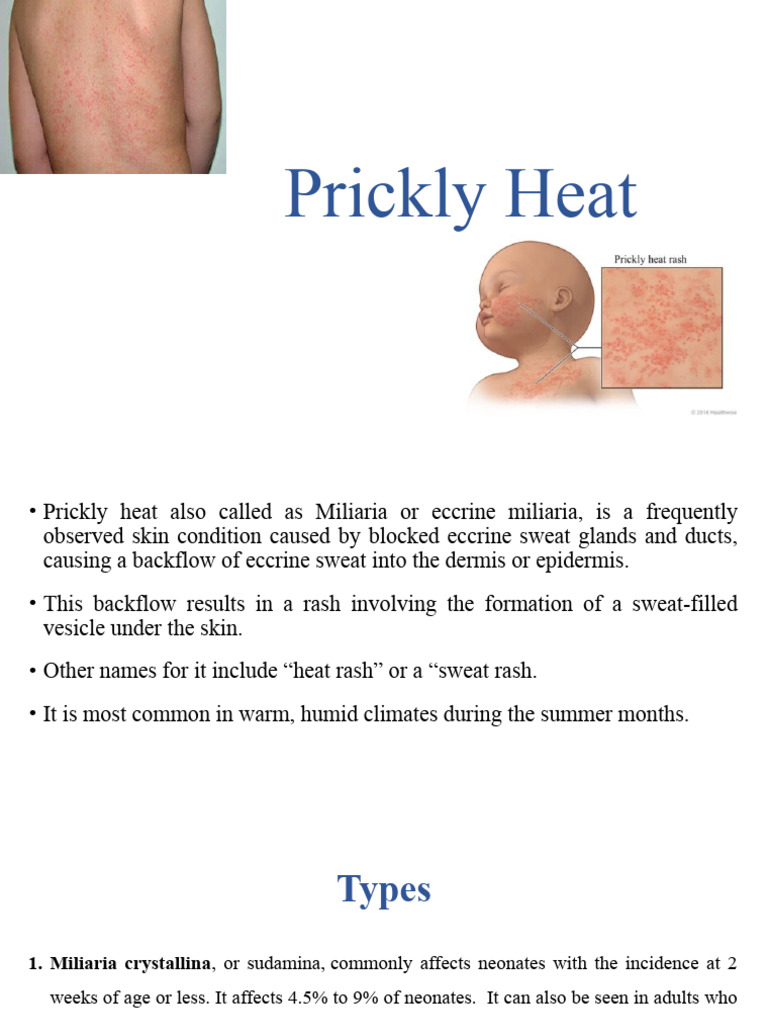 Prickly Heat | PDF | Skin | Clinical Medicine