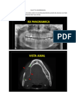 Caso #21 Ameloblastoma