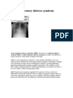 Acute Respiratory Distress Syndrome