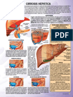 cirrosis_hepatica