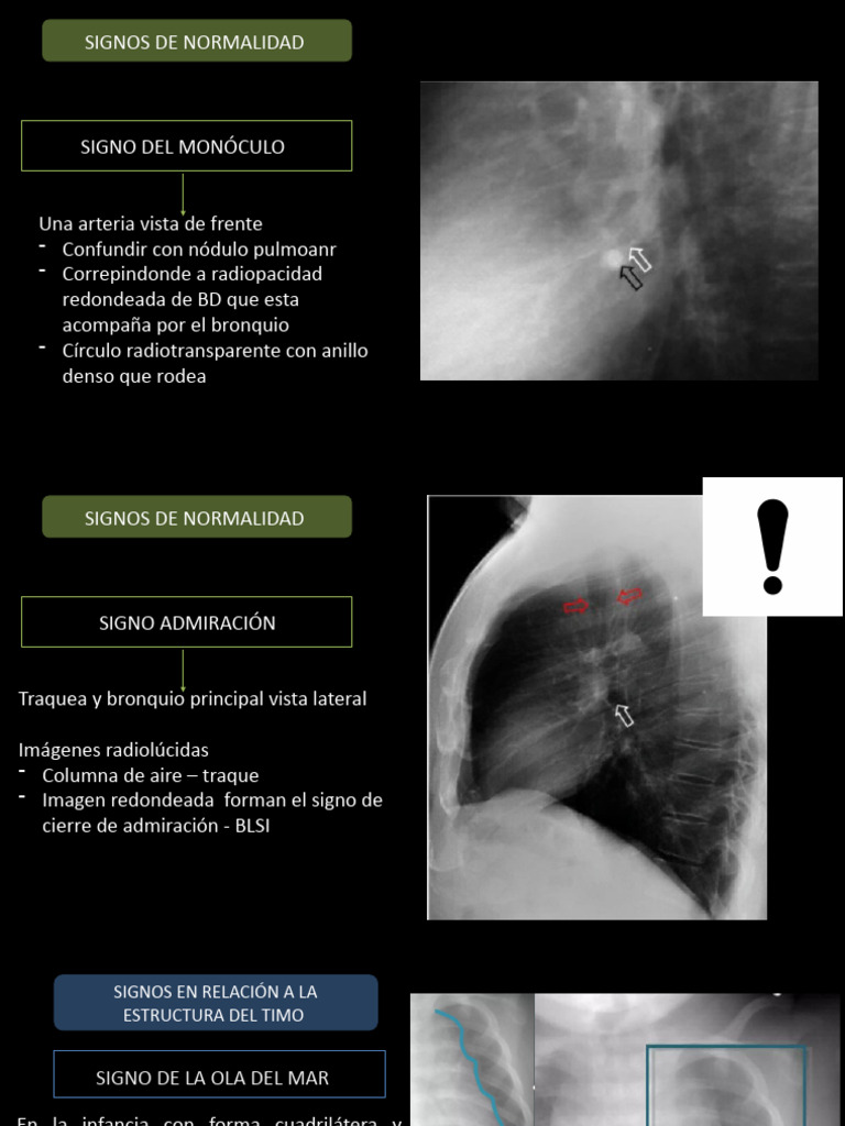 Signos Radiológicos en Tórax y Corazón | PDF | Pulmón | Corazón
