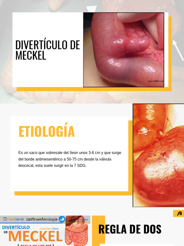 Divertículo de Meckel y Hernia Umbilical | PDF | Causas de la muerte ...