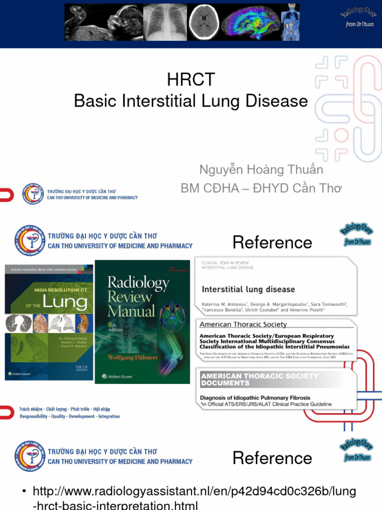 Pulmonary Interstitial Disease 2021 | PDF | Respiratory Diseases ...