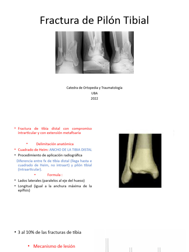 FX Pilon Tibial | Descargar gratis PDF | Hueso | Tobillo