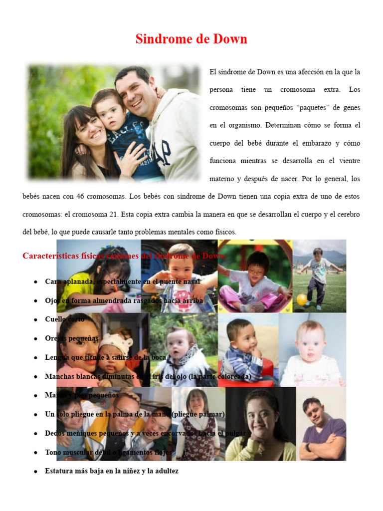 Sindrome e Down | PDF