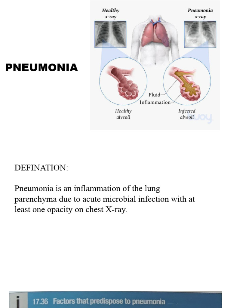 Pneumonia: Types, Complications, and Treatment | PDF | Pneumonia ...
