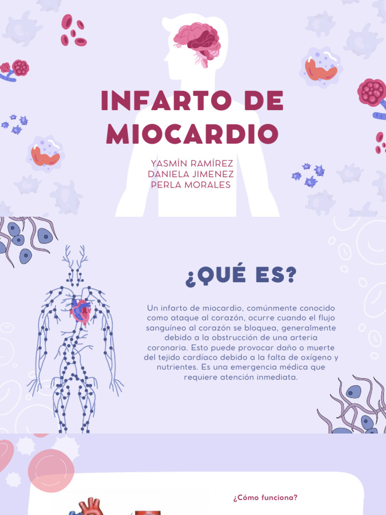 Infarto de Miocardio: Tipos y Prevención | PDF | Infarto de miocardio ...
